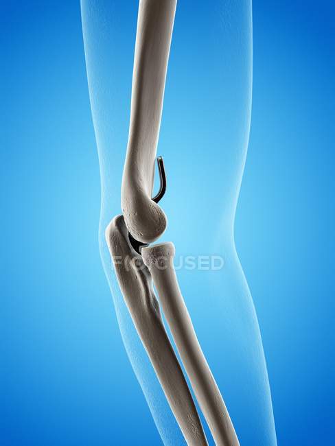 Ilustración de prótesis de reemplazo de codo sobre fondo azul . - foto de stock