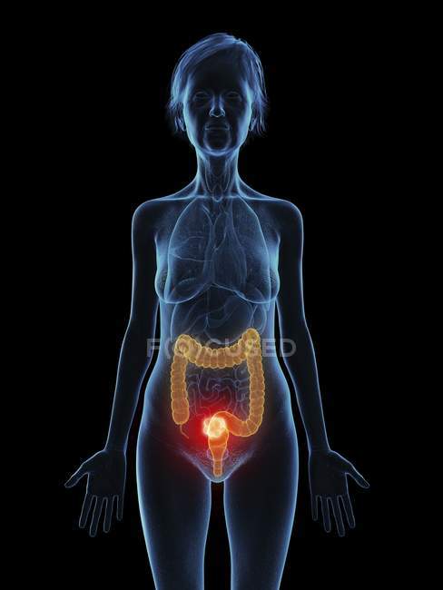 Ilustración de una mujer mayor con tumor de colon sobre fondo negro . - foto de stock