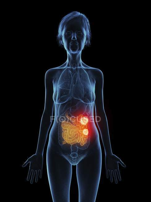 Иллюстрация пожилой женщины с опухолью тонкого кишечника на черном фоне . — стоковое фото