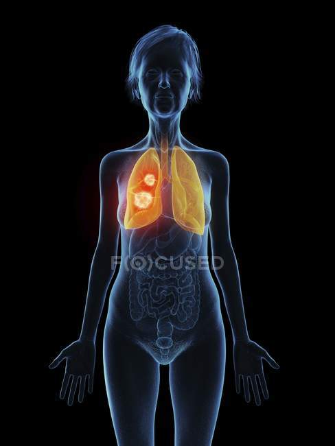 Ілюстрація старший жінка з легенів пухлина на чорному фоні. — стокове фото