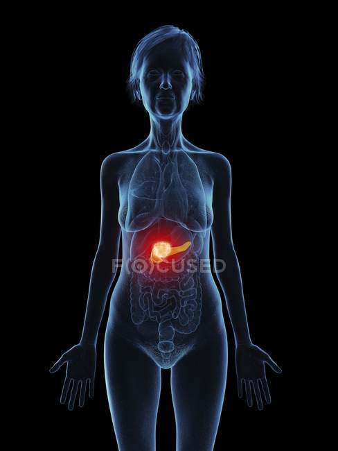 Ilustración de silueta de mujer mayor con tumor de páncreas . - foto de stock