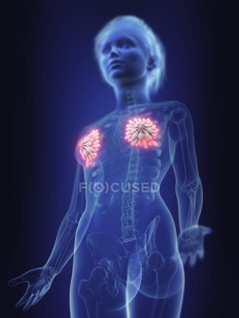 Illustration of inflamed mammary glands in human body. — Stock Photo