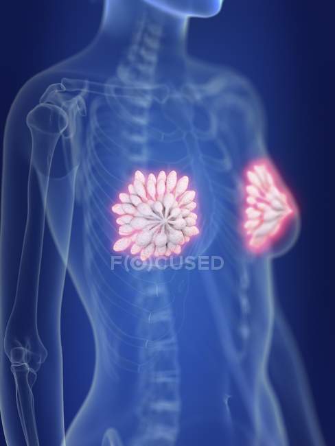Illustration des glandes mammaires enflammées dans le corps humain . — Photo de stock