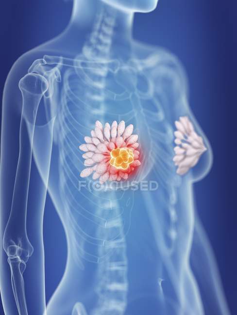 Ilustração da silhueta feminina com câncer de glândulas mamárias destacado . — Fotografia de Stock