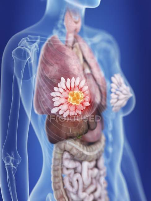 Illustration der weiblichen Silhouette mit hervorgehobenem Brustdrüsenkrebs. — Stockfoto