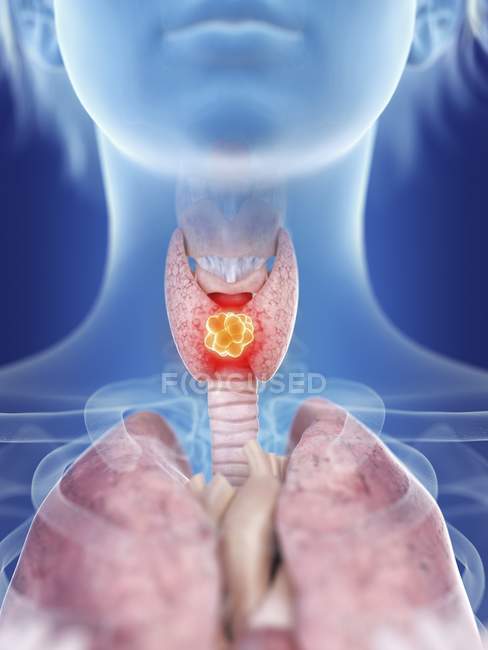Ilustración de la silueta femenina con cáncer de glándula tiroides resaltado . - foto de stock