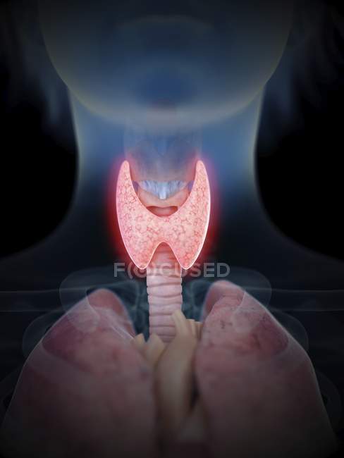 Ilustración de la silueta humana con glándula tiroides inflamada . - foto de stock