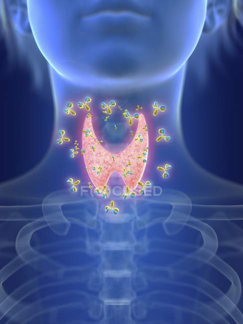 Illustration of human silhouette with inflamed thyroid gland being attacked by antibodies. — Stock Photo