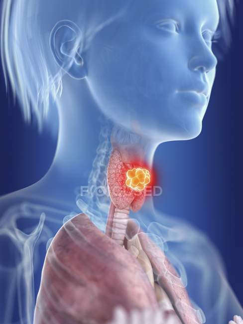Ілюстрація жіночий силует з виділених щитовидної залози рак. — стокове фото