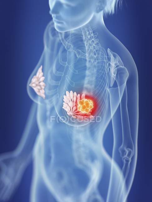 Illustrazione della silhouette femminile con carcinoma mammario evidenziato . — Foto stock