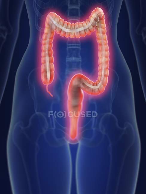Illustration of human silhouette with inflamed colon. — Stock Photo