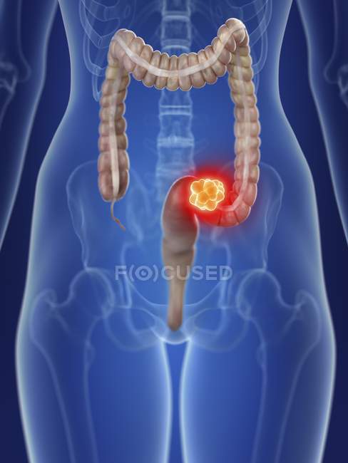 Ilustración de la silueta femenina con cáncer de colon resaltado . - foto de stock