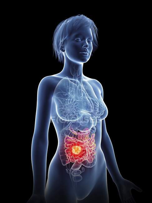 Ilustración de la silueta femenina con cáncer de intestino resaltado
. - foto de stock