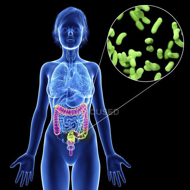Illustration of female silhouette with highlighted colon infection. — Stock Photo