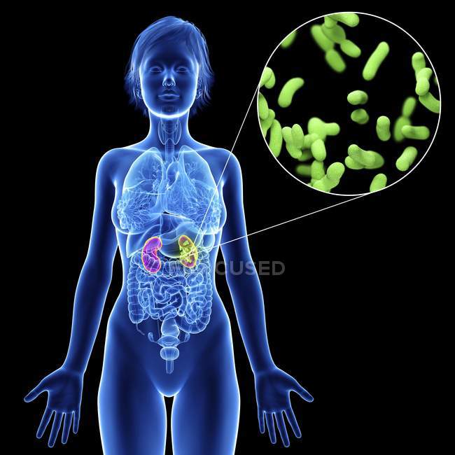 Illustration der weiblichen Silhouette mit hervorgehobener Niereninfektion. — Stockfoto