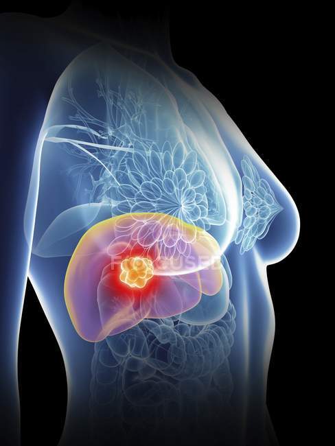 Ilustración de la silueta femenina con cáncer de hígado resaltado
. - foto de stock