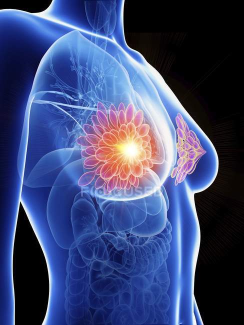 Ilustración de silueta femenina con glándulas mamarias inflamadas . - foto de stock
