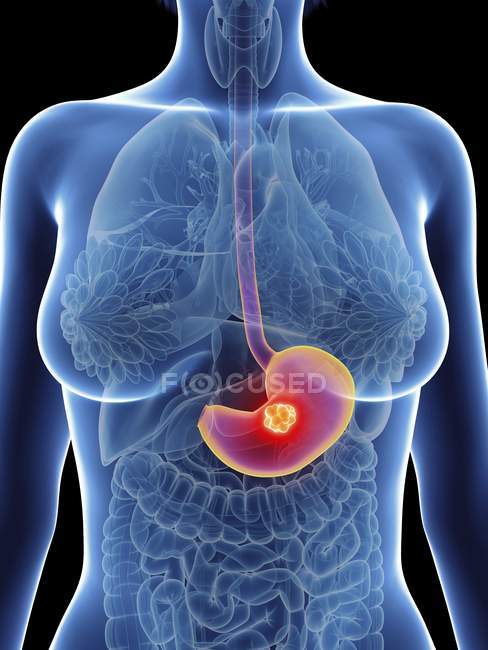 Ilustración de la silueta femenina con cáncer de estómago resaltado . - foto de stock