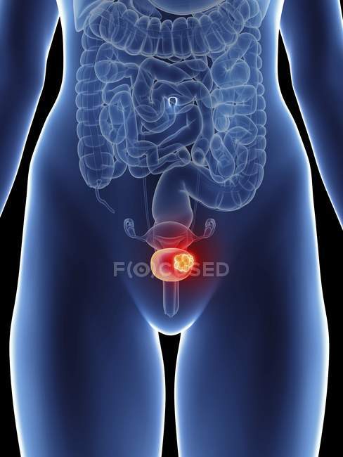 Illustration de la silhouette féminine avec cancer de la vessie mis en évidence . — Photo de stock