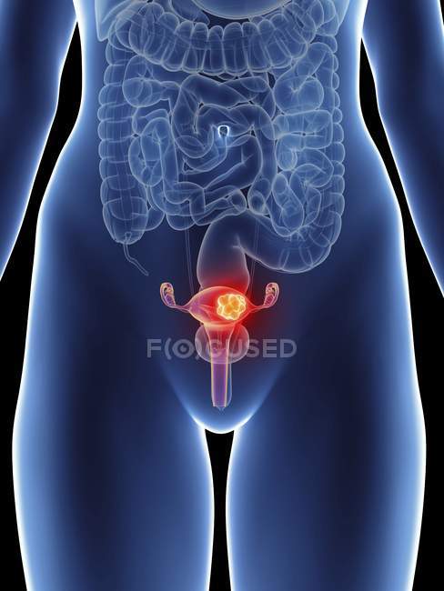 Illustration of female silhouette with highlighted uterus cancer. — Stock Photo