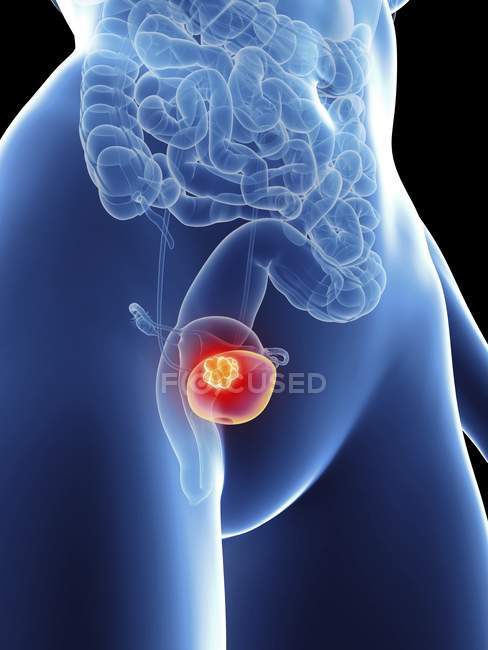 Ilustración de la silueta femenina con cáncer de vejiga resaltado . - foto de stock