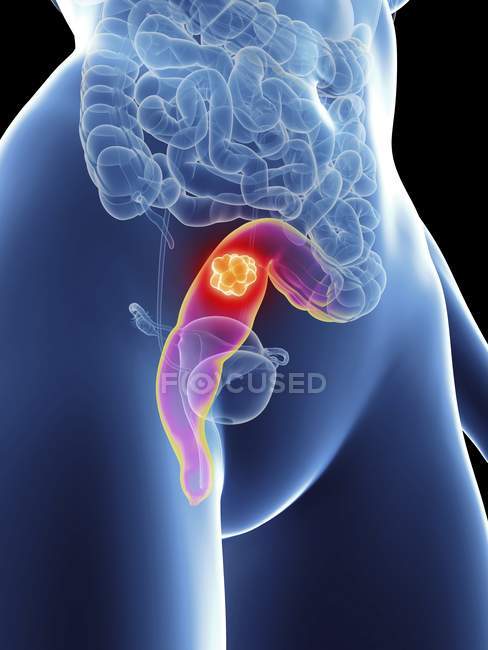 Ilustración de la silueta femenina con cáncer de recto resaltado . - foto de stock