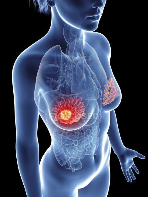 Ilustración de silueta femenina con cáncer de glándulas mamarias . - foto de stock