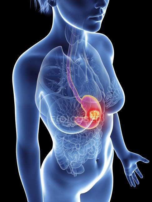 Ilustración de la silueta femenina con cáncer de estómago resaltado . - foto de stock