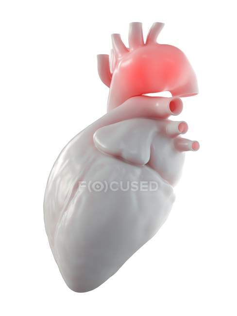 Ілюстрація аневризма аорти в людському серці. — стокове фото