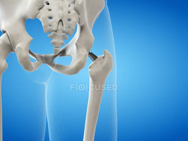 Ilustración del implante de metal de reemplazo de cadera sobre fondo azul . - foto de stock