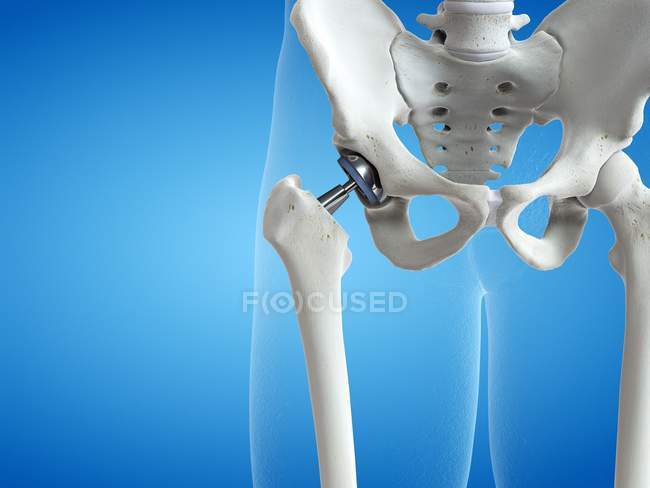 Illustration of hip replacement metal implant on blue background. — Stock Photo