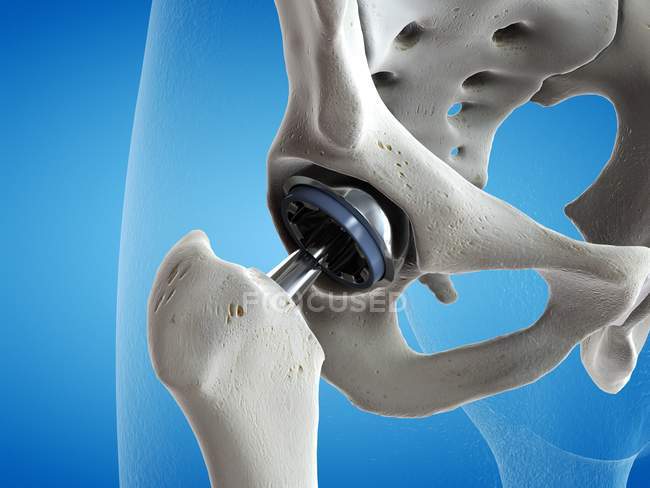 Ilustração do implante de metal de substituição do quadril no fundo azul . — Fotografia de Stock