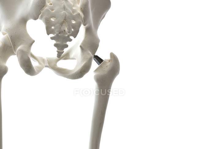 Ilustração do implante de metal de substituição da anca sobre fundo branco . — Fotografia de Stock
