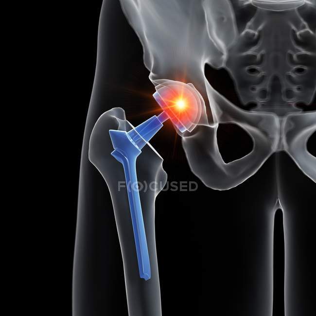 Illustrazione della sostituzione dell'anca dolorante su sfondo nero . — Foto stock