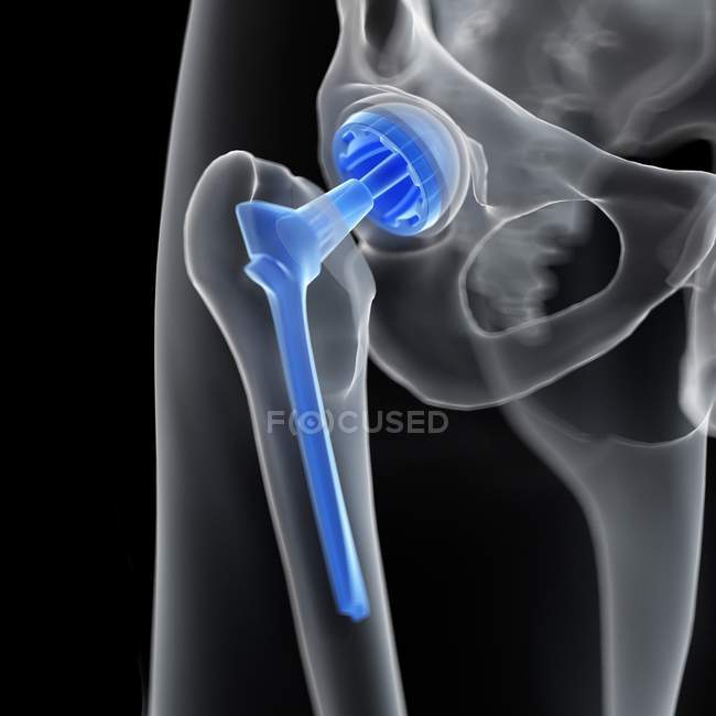 Ilustración del reemplazo médico de cadera sobre fondo negro . - foto de stock