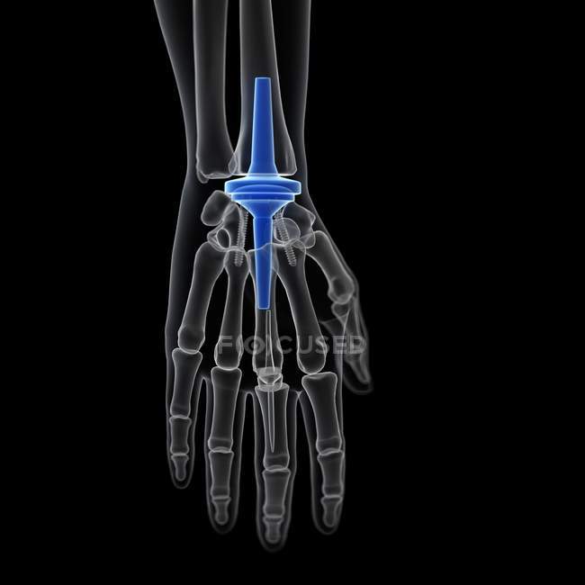Illustration of wrist replacement on black background. — Stock Photo