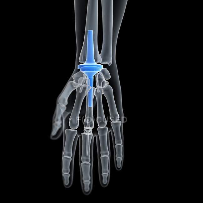 Illustration of wrist replacement on black background. — Stock Photo
