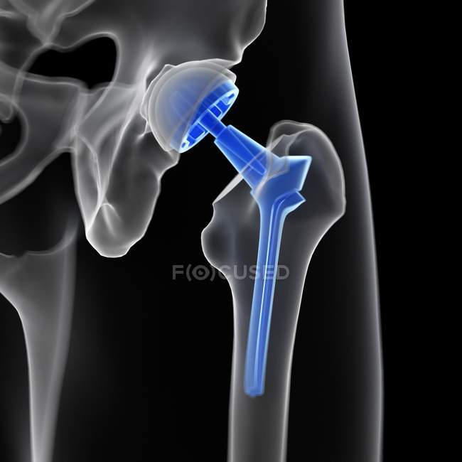 Illustration of medical hip replacement on black background. — Stock Photo