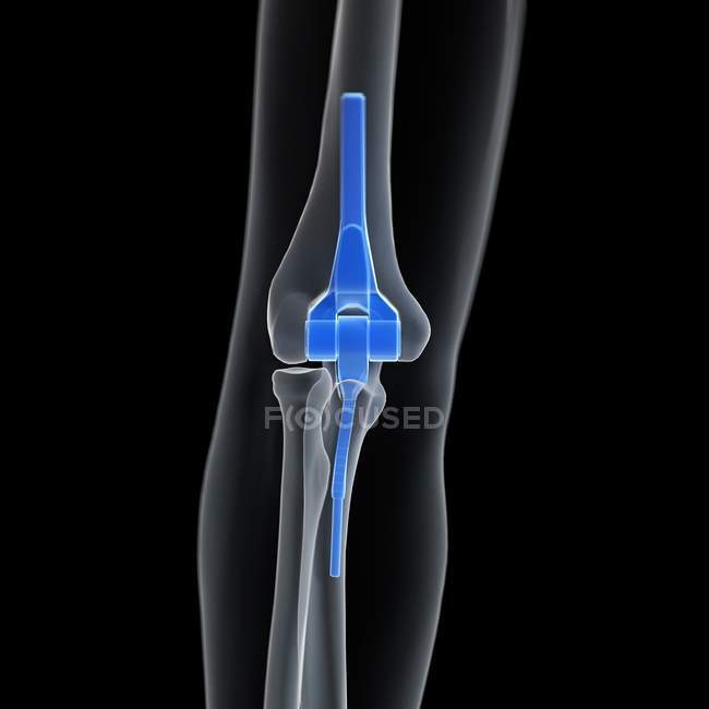 Illustration of elbow replacement in human skeleton. — Stock Photo