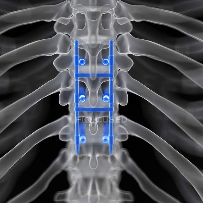 Illustrazione della fusione spinale nello scheletro umano . — Foto stock