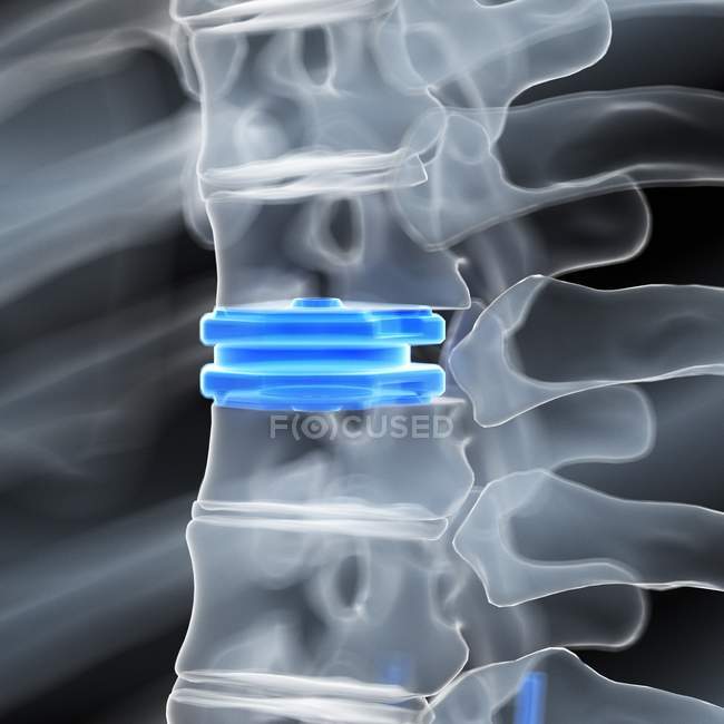 Illustration of disc replacement in human skeleton. — Stock Photo