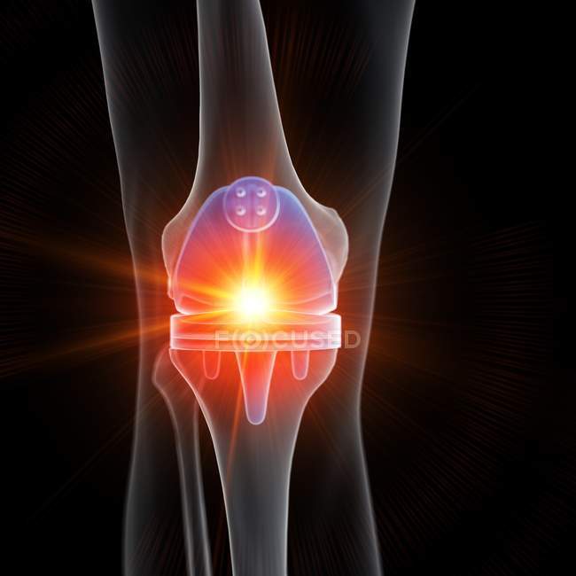 Ilustração médica de substituição de joelho dolorido em fundo preto . — Fotografia de Stock