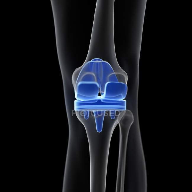 Medizinische Illustration des Knieersatzes auf schwarzem Hintergrund. — Stockfoto