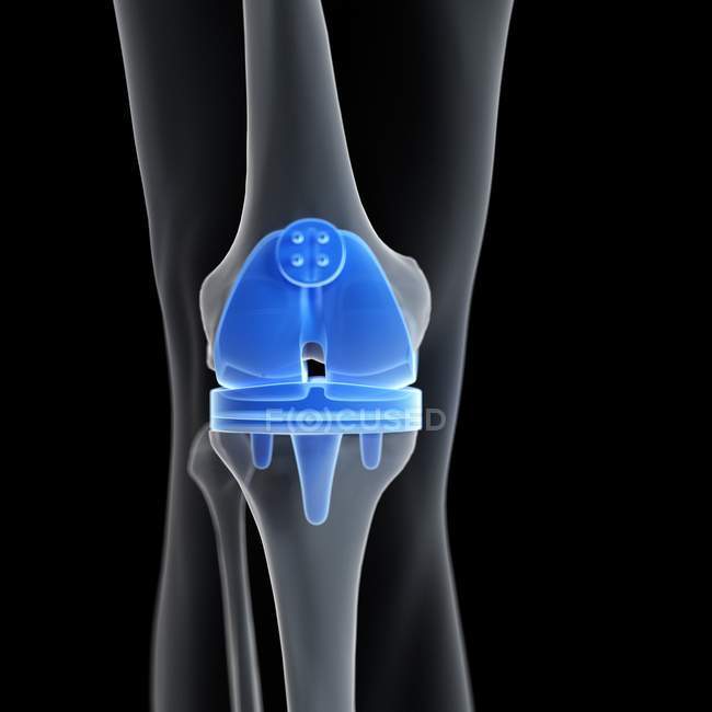 Medizinische Illustration des Knieersatzes auf schwarzem Hintergrund. — Stockfoto