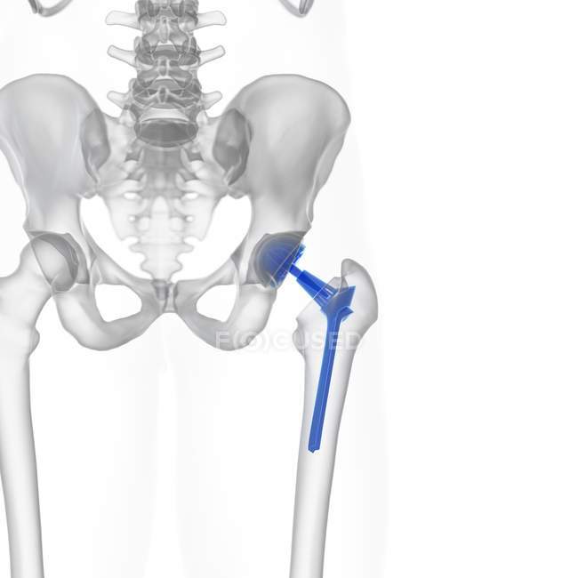 Ilustración de prótesis de reemplazo de cadera sobre fondo blanco . - foto de stock
