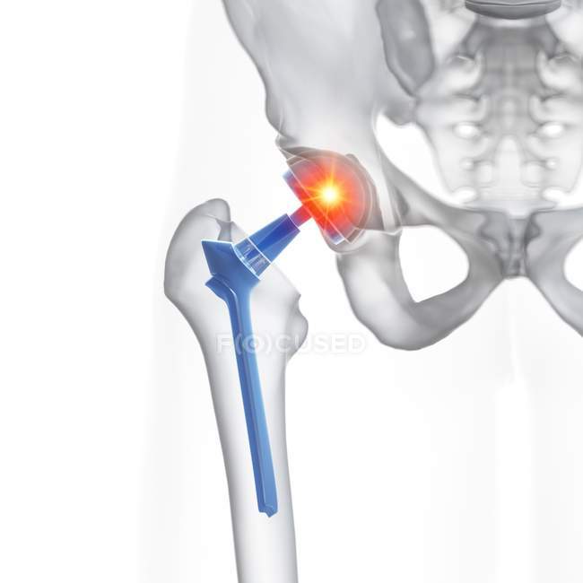 Illustration of hip replacement prosthesis with pain on white background. — Stock Photo