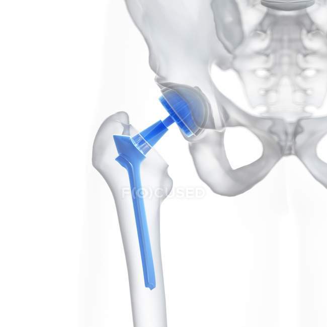 Illustration der Hüftprothese auf weißem Hintergrund. — Stockfoto
