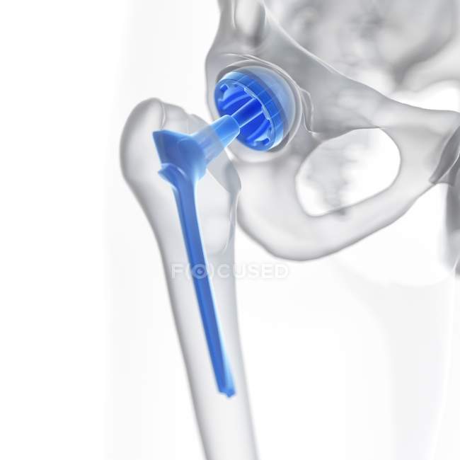 Illustrazione della protesi di sostituzione dell'anca su fondo bianco . — Foto stock