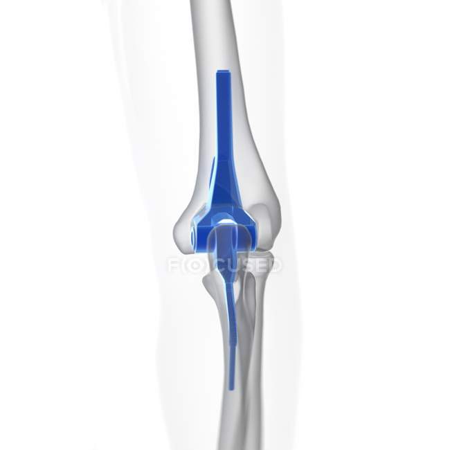 Ilustración de prótesis de reemplazo azul codo sobre fondo blanco . - foto de stock