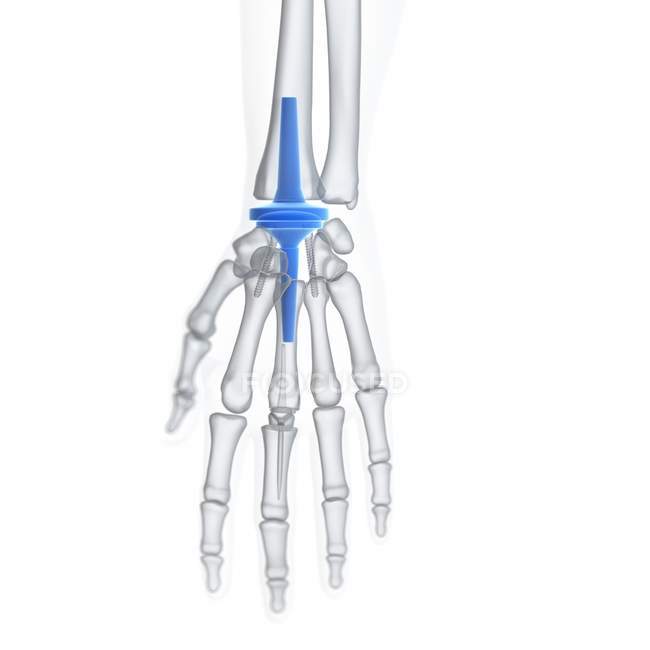 Ilustração do implante de substituição de pulso sobre fundo branco
. — Fotografia de Stock